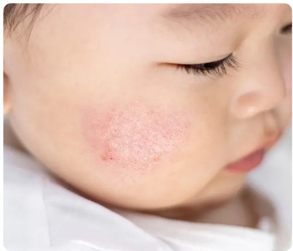 Baby with Atopic Eczema